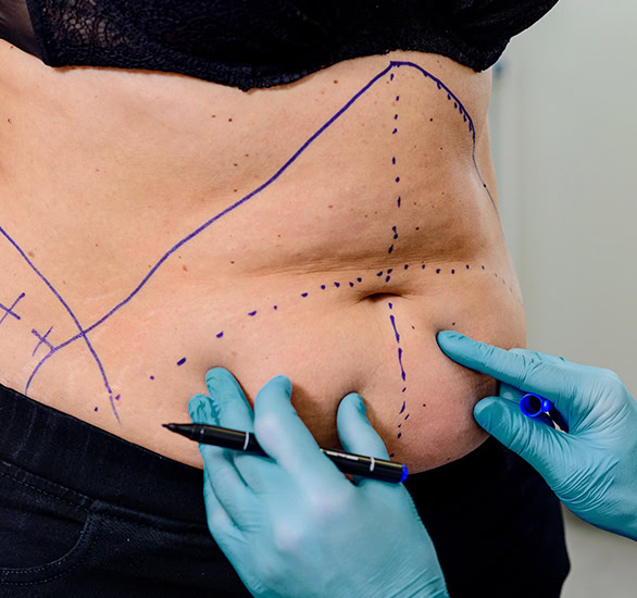 Lipoplastika / Liposukce